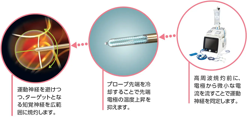 ラジオ波治療システムとは