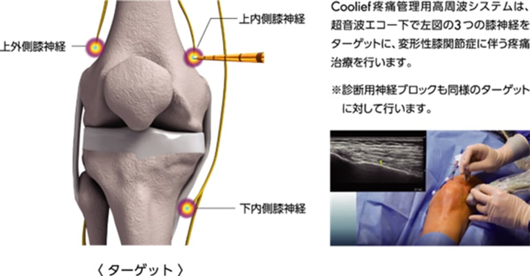 ラジオ波治療システムとは